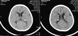 結節性硬化症CT影像