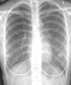 胸膜粘連 胸膜粘連