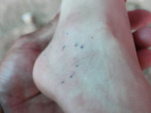 海膽刺傷及海膽肉芽腫 海膽刺傷及海膽肉芽腫