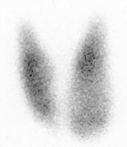 妊娠合併甲狀腺機能亢進 妊娠合併甲狀腺機能亢進