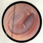 急性卡他性中耳炎