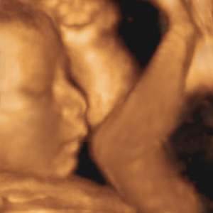 （圖）四維彩超