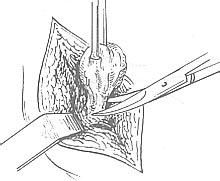 《乳腺良性腫瘤切除術》 《乳腺良性腫瘤切除術》