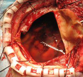 開顱血腫清除術 開顱血腫清除術