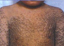 性聯尋常性魚鱗病 性聯尋常性魚鱗病