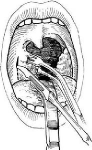 扁桃體剝離術 扁桃體剝離術