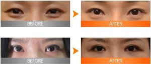 雙眼皮修復術前後照片