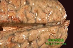 克雷伯氏菌感染