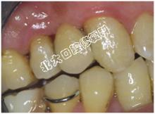 粘接修復口腔表現