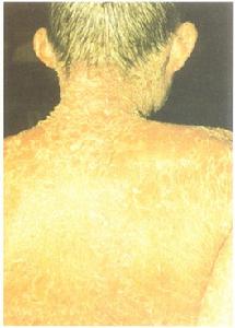 乾燥性角膜結膜炎