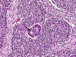 松果體細胞瘤 松果體細胞瘤