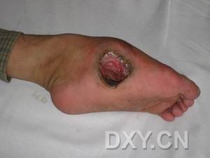 脊膜膨出與脊膜脊髓膨出