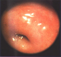 （圖）正常宮頸