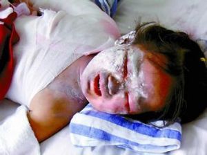 熱燙傷目 熱燙傷目