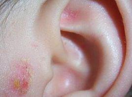 外耳道癬 外耳道癬