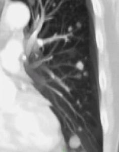 原發性肺動脈高壓