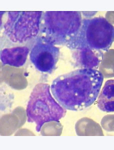 淋巴細胞減少症 淋巴細胞減少症