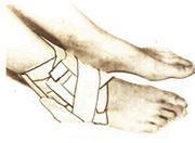 外踝前下方腫脹和疼痛 外踝前下方腫脹和疼痛