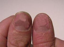 指甲營養障礙 指甲營養障礙