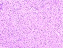 （圖）肛管直腸惡性黑色素瘤