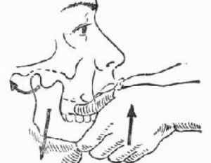 顳下頜關節脫位 顳下頜關節脫位