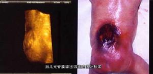 脊膜膨出與脊膜脊髓膨出