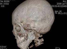 半側面部發育不良 半側面部發育不良