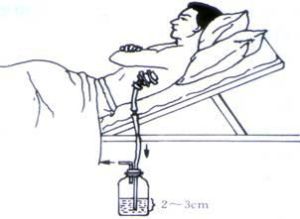 胸腔閉式引流術