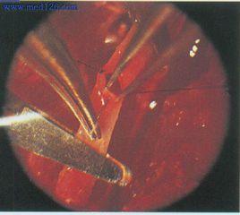 血管端端吻合術 血管端端吻合術