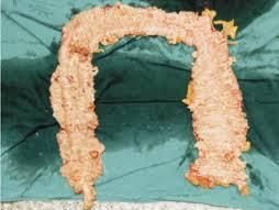 家族性結腸息肉 家族性結腸息肉