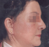 面部皺紋祛除術