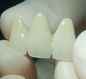 鎳鉻烤瓷牙 鎳鉻烤瓷牙