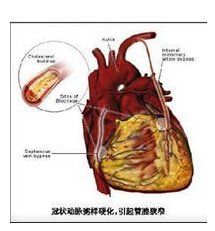 急性冠狀動脈綜合徵