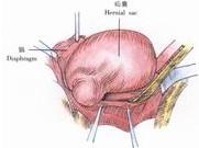 示意圖9:突入胸腔的疝囊