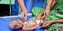 印度男嬰患“人體自燃症”