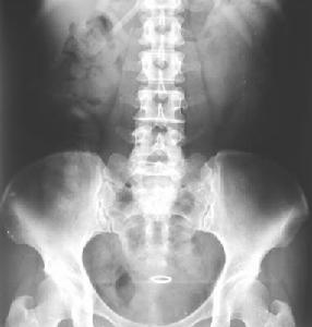 腹部平片 腹部平片