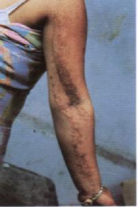 線狀表皮痣 線狀表皮痣