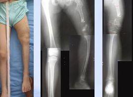 下肢短縮 下肢短縮