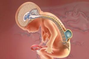 脊膜膨出 脊膜膨出