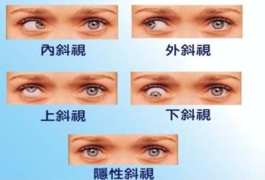 共同性外斜視 共同性外斜視