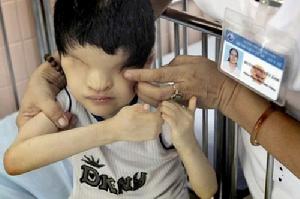 越南兒童因橙劑一出生就沒有眼睛