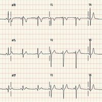 心源性心臟病 心源性心臟病