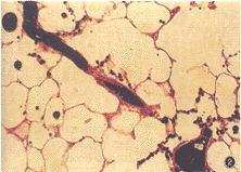 肺組織細胞增生症