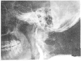 外傷性頸內動脈海綿竇瘺