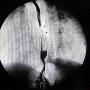 食道裂口疝 食道裂口疝