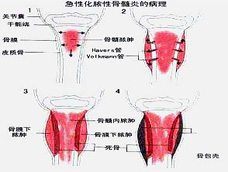放射性脊髓病 放射性脊髓病