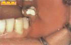 牙槽膿腫