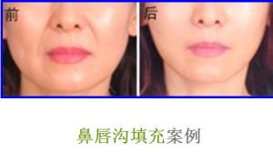 鼻唇溝填充案例