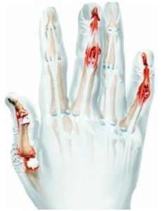 銀屑病關節炎 銀屑病關節炎