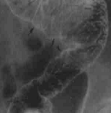 先天性巨結腸症